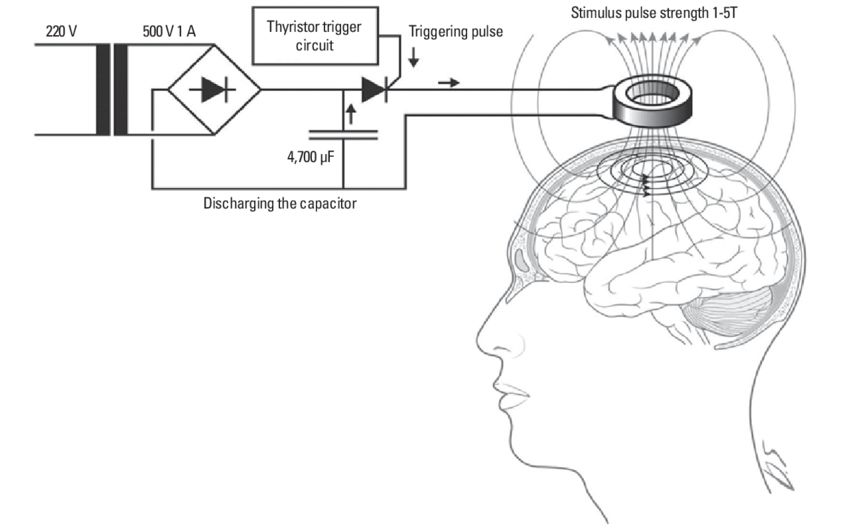 tms什么医疗技术 ｜ 最“科学”的磁疗方法：经颅磁刺激_https://www.jmylbn.com_新闻资讯_第3张