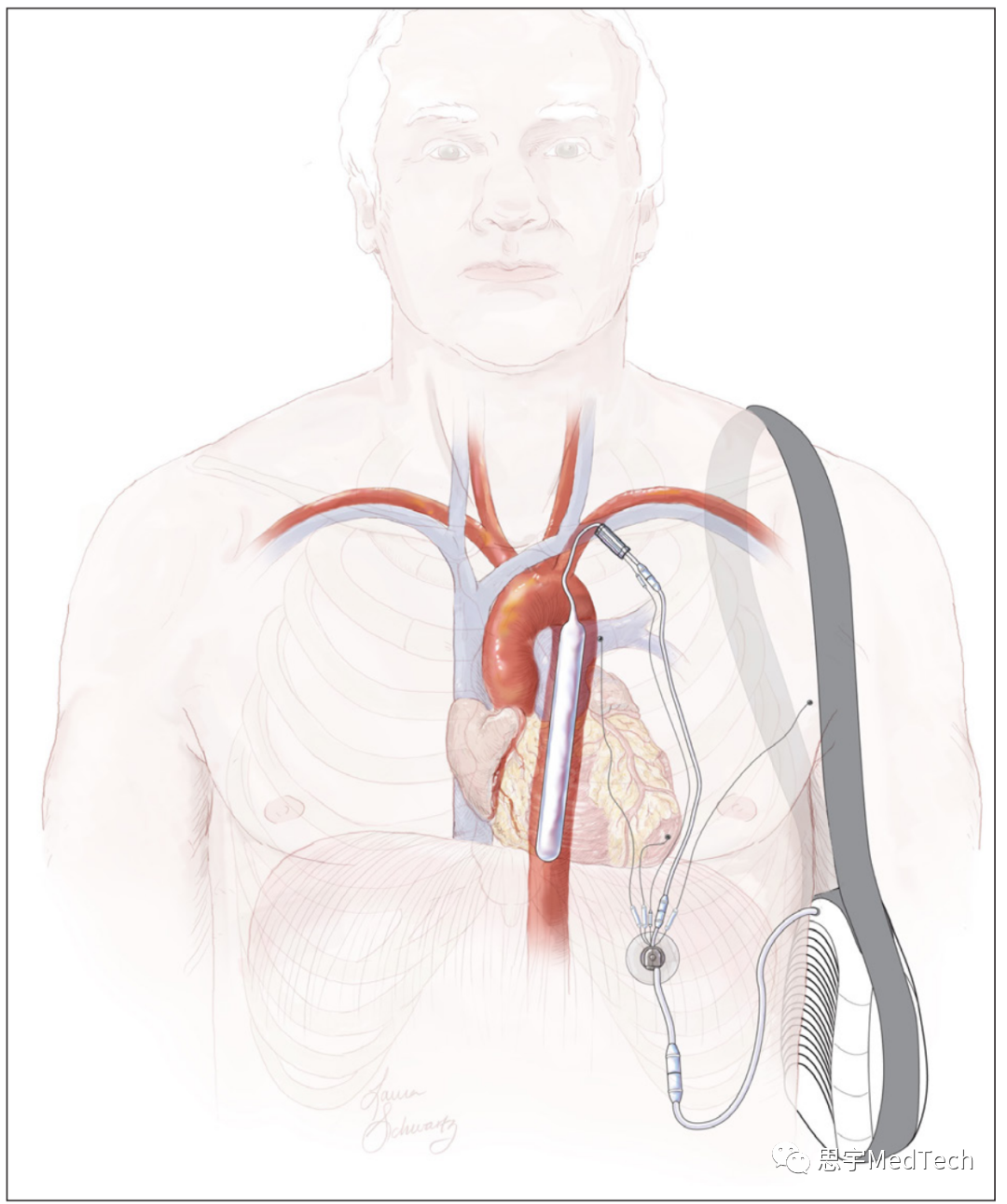 医生专栏 | 下一代人工心脏(图5)