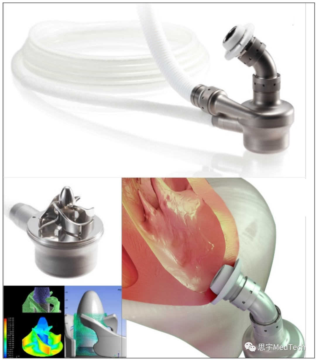 医生专栏 | 下一代人工心脏(图1)