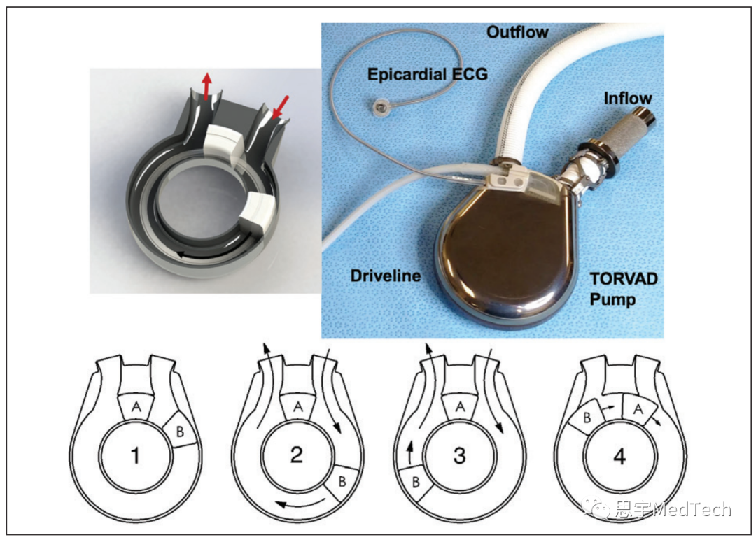 医生专栏 | 下一代人工心脏(图6)