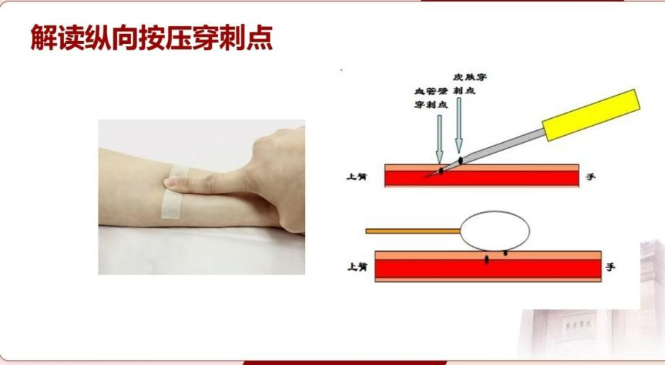 为什么输血不能用小针“静”系生命   “针”心呵护_https://www.jmylbn.com_新闻资讯_第9张