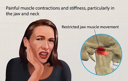 破伤风的最普遍和最严重的临床表现是全身性破伤风.