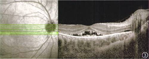 oct示右眼黄斑区视网膜神经上皮层与色素上皮层分离,神经上皮层反射