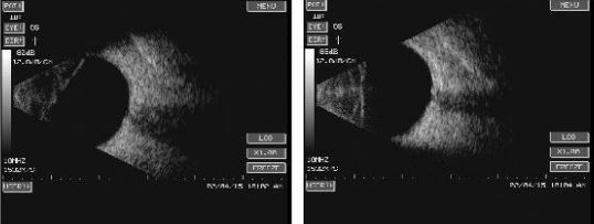 眼科ab超怎么使用不同眼科疾病的超声诊断_https://www.jmylbn.com_新闻资讯_第3张