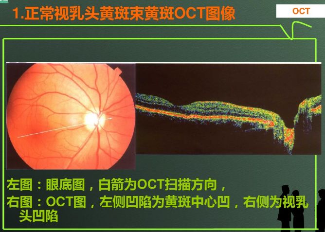 眼科新手必读 Oct结果解读