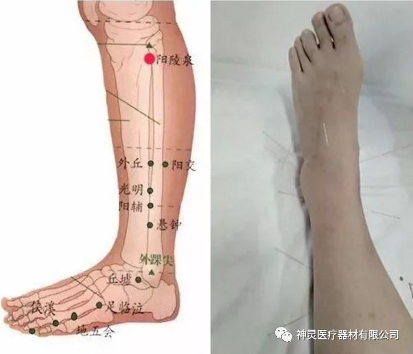 中医篇针灸治疗脚扭伤 神灵医疗器材有限公司 微信公众号文章阅读 Wemp