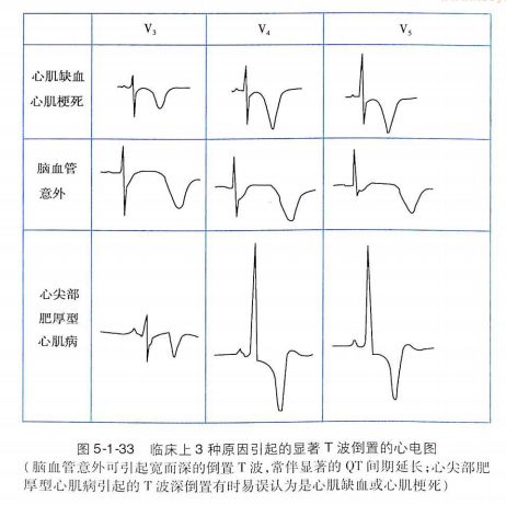 心肌缺血的表现及缓解控制 宿迁新闻