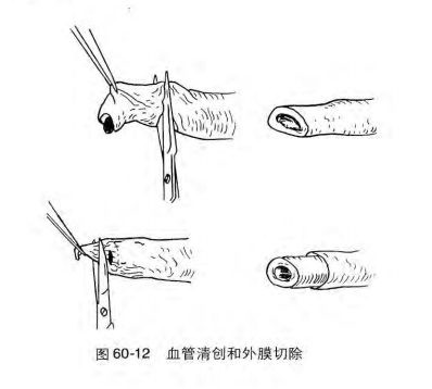怎么区分显微剪刀医学科普：显微外科技术_https://www.jmylbn.com_新闻资讯_第4张