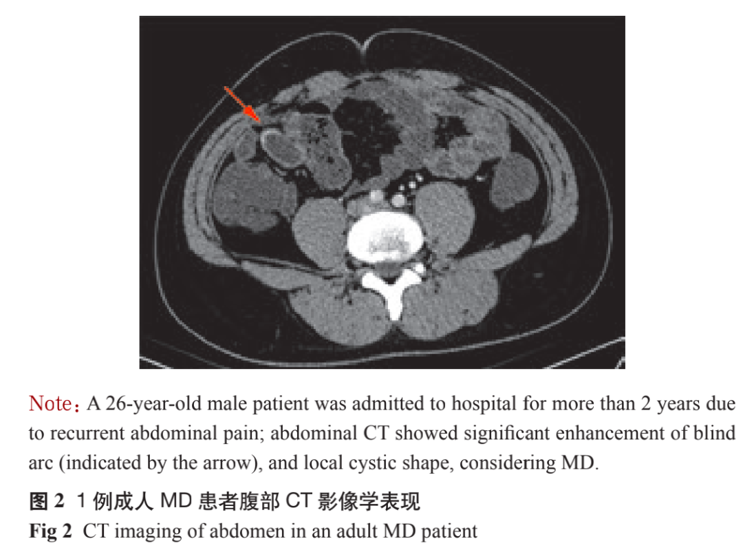 md是胎儿的什么梅克尔憩室（Meckel diverticulum，MD）-上海聚慕医疗器械有限公司