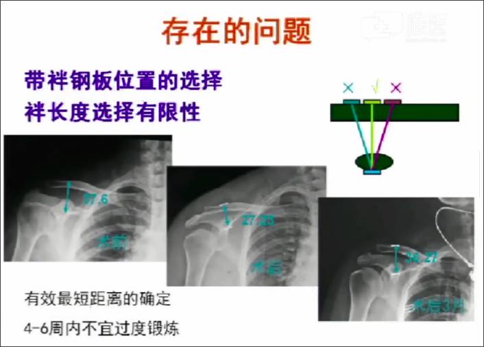 78亮點二:以肩鎖鉤鋼板為代表的剛性固定存在的缺點.