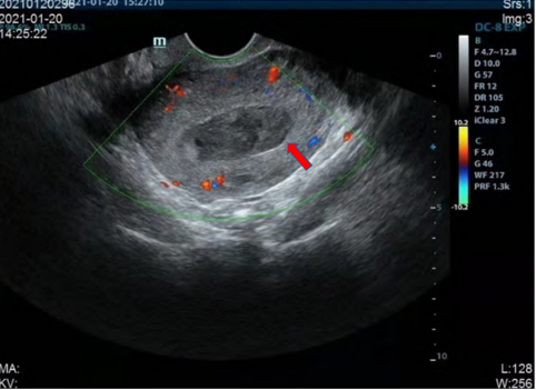 导什么针什么作用【以案说医】庄礼兴：从合谷、三阴交论导气同精针法促排宫内残留案_https://www.jmylbn.com_新闻资讯_第3张