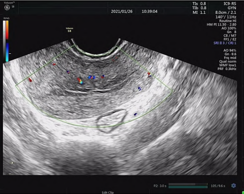 导什么针什么作用【以案说医】庄礼兴：从合谷、三阴交论导气同精针法促排宫内残留案_https://www.jmylbn.com_新闻资讯_第4张