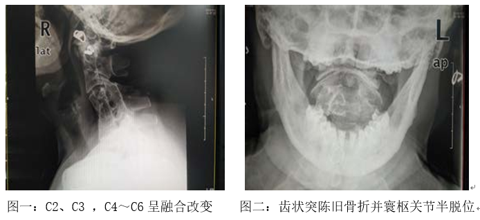 气血通络仪效果怎么样【以案说医】范德辉：补益气血 通络止痛法治疗混合型颈椎病合并寰枢关节半脱位案_https://www.jmylbn.com_新闻资讯_第1张