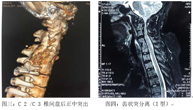 气血通络仪效果怎么样【以案说医】范德辉：补益气血 通络止痛法治疗混合型颈椎病合并寰枢关节半脱位案_https://www.jmylbn.com_新闻资讯_第2张