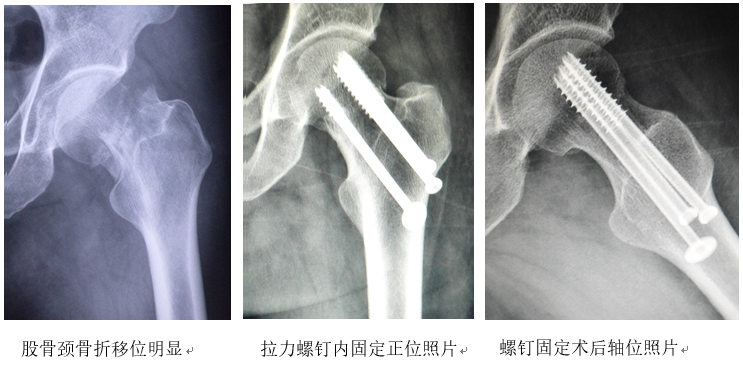 以案說醫彭力平治療股骨頸頭下骨折經驗