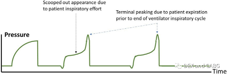 呼吸机是怎么给压力的机械通气的基本方式_https://www.jmylbn.com_新闻资讯_第24张