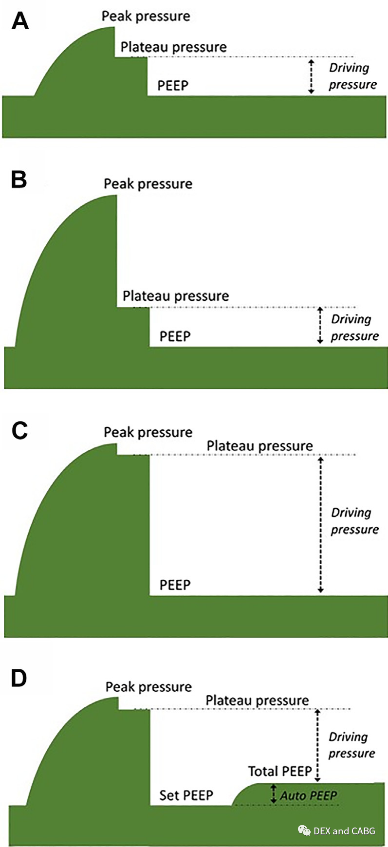 呼吸机是怎么给压力的机械通气的基本方式_https://www.jmylbn.com_新闻资讯_第16张