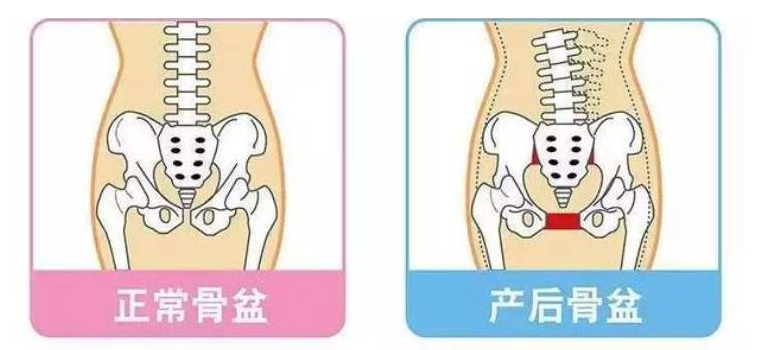 为什么要做骨盆修复？看完我震惊了！