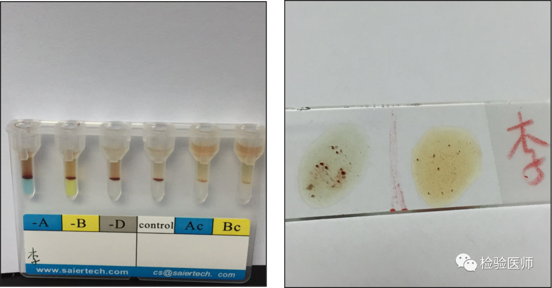 血型鉴定很多坑?都在这里了._医学界-助力医生临床决策和职业成长