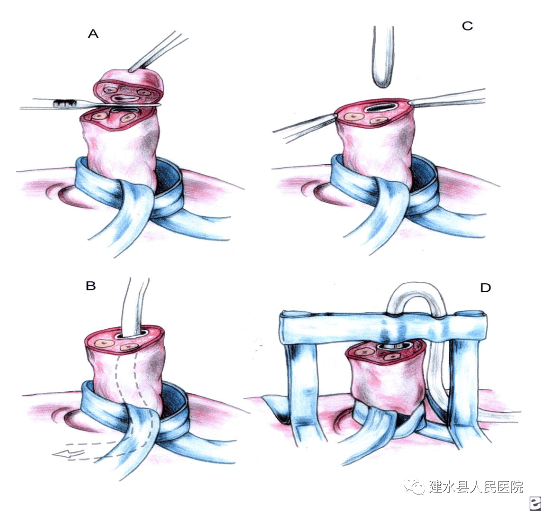 为什么新生儿抢救台【健康科普】早产儿生命的管道-脐静脉置管术_https://www.jmylbn.com_新闻资讯_第3张