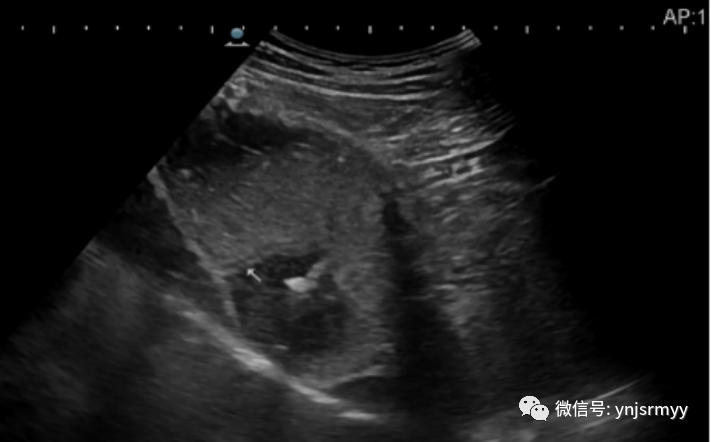 什么是260胃镜胃肠不适，不想做胃镜，建水县人民医院胃肠超声造影检查能看！_https://www.jmylbn.com_新闻资讯_第17张