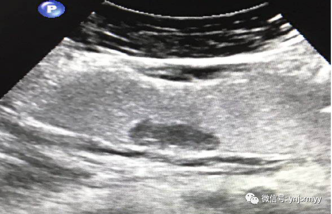 什么是260胃镜胃肠不适，不想做胃镜，建水县人民医院胃肠超声造影检查能看！_https://www.jmylbn.com_新闻资讯_第18张