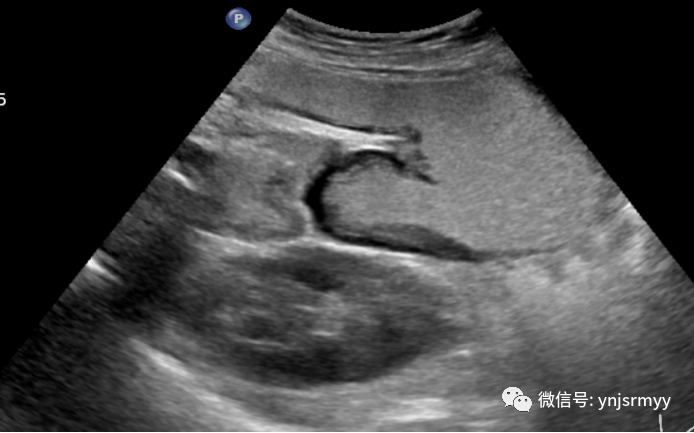 什么是260胃镜胃肠不适，不想做胃镜，建水县人民医院胃肠超声造影检查能看！_https://www.jmylbn.com_新闻资讯_第15张