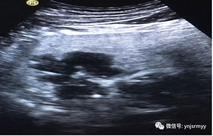 什么是260胃镜胃肠不适，不想做胃镜，建水县人民医院胃肠超声造影检查能看！_https://www.jmylbn.com_新闻资讯_第16张