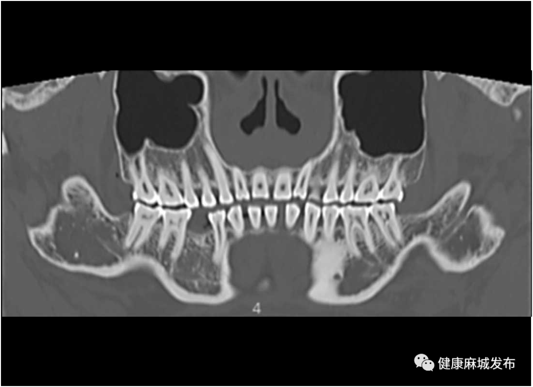 联影ct怎么样喜讯！麻城市四医院新添“大武器”——联影全智能天眼40排螺旋CT_https://www.jmylbn.com_新闻资讯_第6张