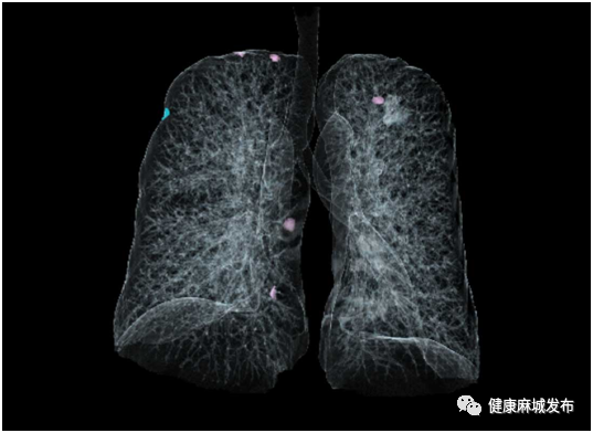 联影ct怎么样喜讯！麻城市四医院新添“大武器”——联影全智能天眼40排螺旋CT_https://www.jmylbn.com_新闻资讯_第3张