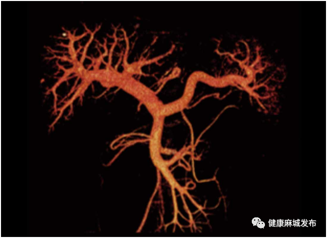 联影ct怎么样喜讯！麻城市四医院新添“大武器”——联影全智能天眼40排螺旋CT_https://www.jmylbn.com_新闻资讯_第4张