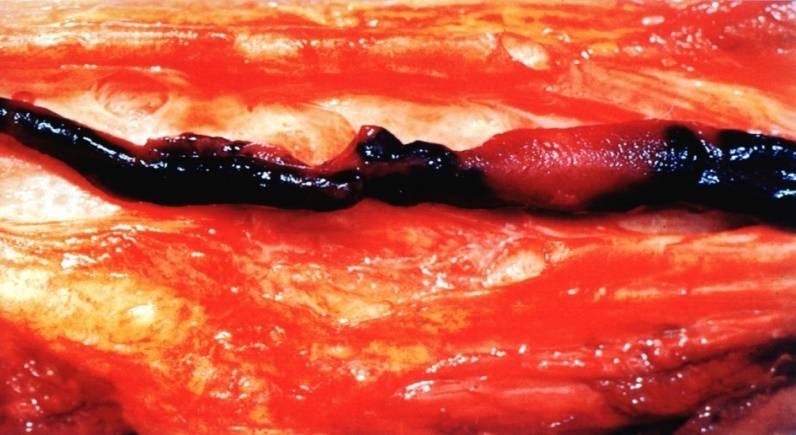 发病机制 rudolph virchow 1858年提出vte形成 三联理论