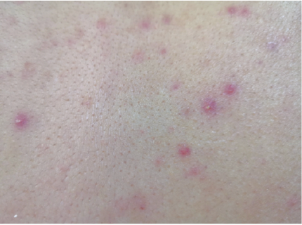 又疼又痒！头皮、后背长了小疙瘩，是什么？