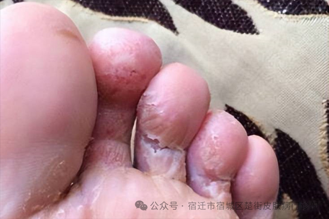 【宿迁楚街皮肤病医院】专业解析手足癣（脚气）防治，守护您的足部健康！