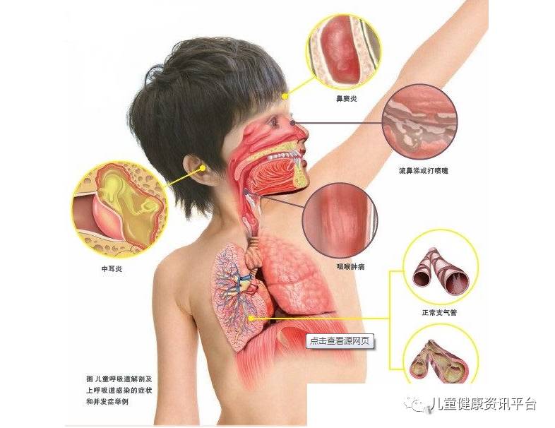 急性上呼吸道感染