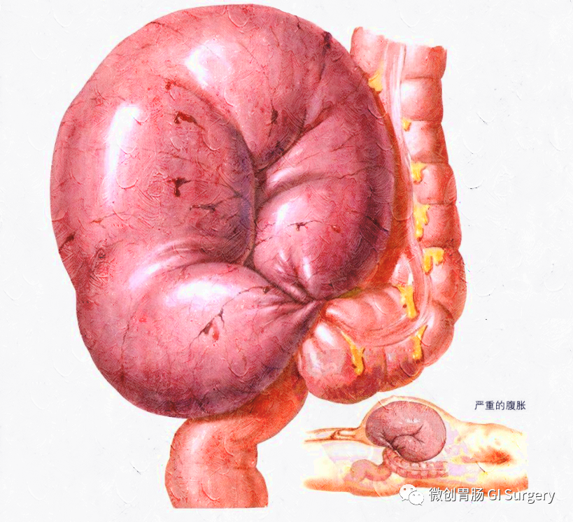 急腹症的外科处理系列之乙状结肠扭转_医学界-助力医生临床决策和职业
