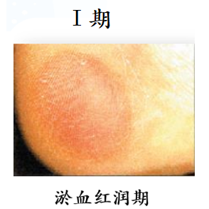 防压疮垫叫什么【辅具学堂】防压疮垫妙用知多少？_https://www.jmylbn.com_新闻资讯_第1张