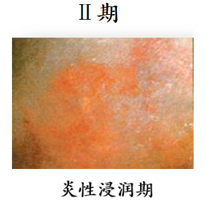 防压疮垫叫什么【辅具学堂】防压疮垫妙用知多少？_https://www.jmylbn.com_新闻资讯_第2张