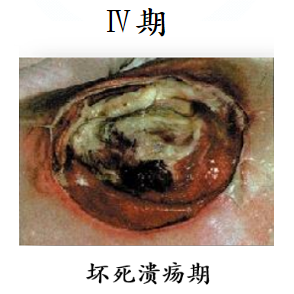 防压疮垫叫什么【辅具学堂】防压疮垫妙用知多少？_https://www.jmylbn.com_新闻资讯_第5张