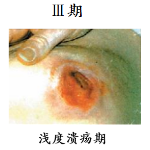 防压疮垫叫什么【辅具学堂】防压疮垫妙用知多少？_https://www.jmylbn.com_新闻资讯_第3张