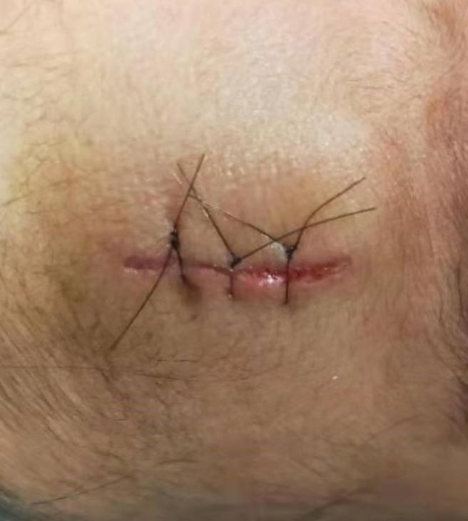 医生为什么缝合不用细线【儿医科普】娃的小脸蛋磕破怕留疤？莫慌！美容缝合术来帮忙！_https://www.jmylbn.com_新闻资讯_第7张