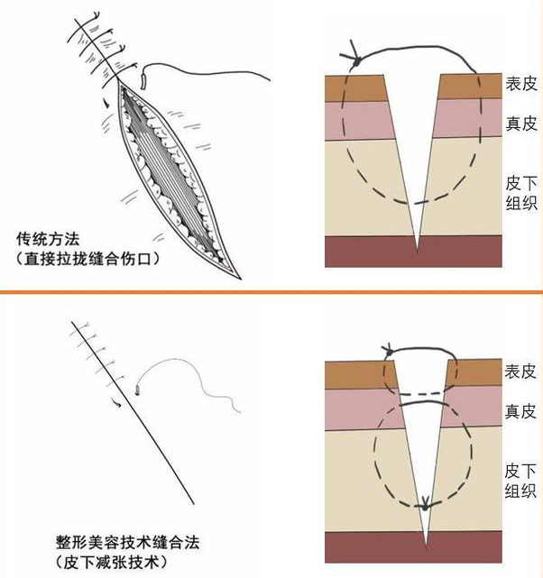 医生为什么缝合不用细线【儿医科普】娃的小脸蛋磕破怕留疤？莫慌！美容缝合术来帮忙！_https://www.jmylbn.com_新闻资讯_第6张
