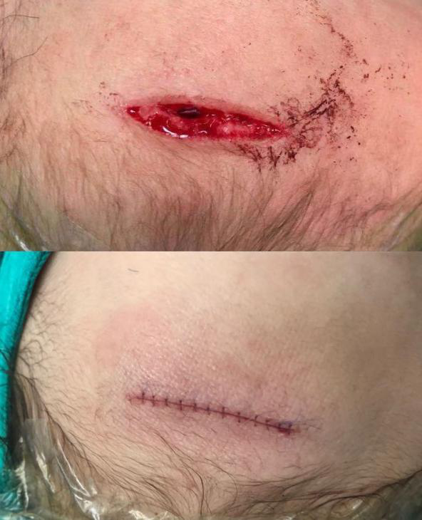 医生为什么缝合不用细线【儿医科普】娃的小脸蛋磕破怕留疤？莫慌！美容缝合术来帮忙！_https://www.jmylbn.com_新闻资讯_第8张