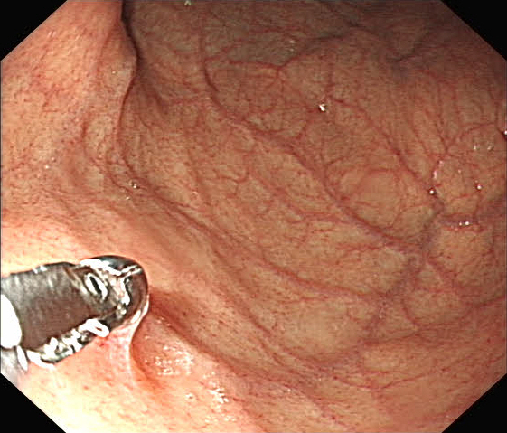 为什么说热活检钳做胃肠镜检查时，为什么要取活检？有必要吗？_https://www.jmylbn.com_新闻资讯_第2张