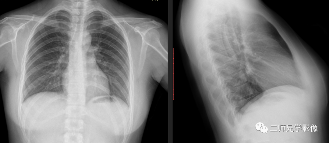 怎么取放射片放射拍片中的“几何学”，临床医生和技师都掌握了吗？_https://www.jmylbn.com_新闻资讯_第9张