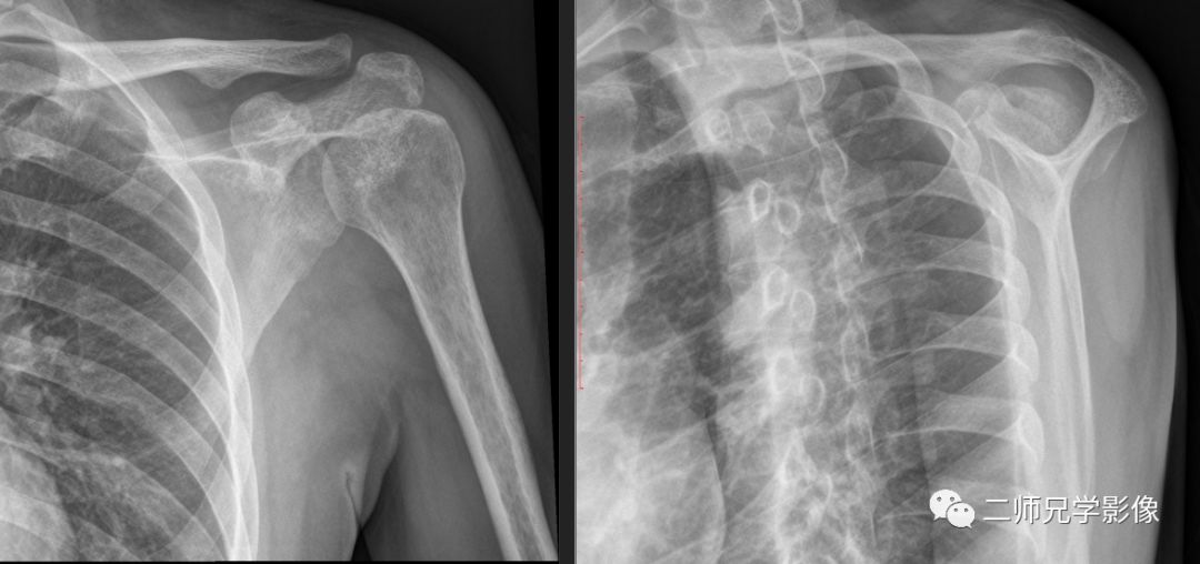 怎么取放射片放射拍片中的“几何学”，临床医生和技师都掌握了吗？_https://www.jmylbn.com_新闻资讯_第8张