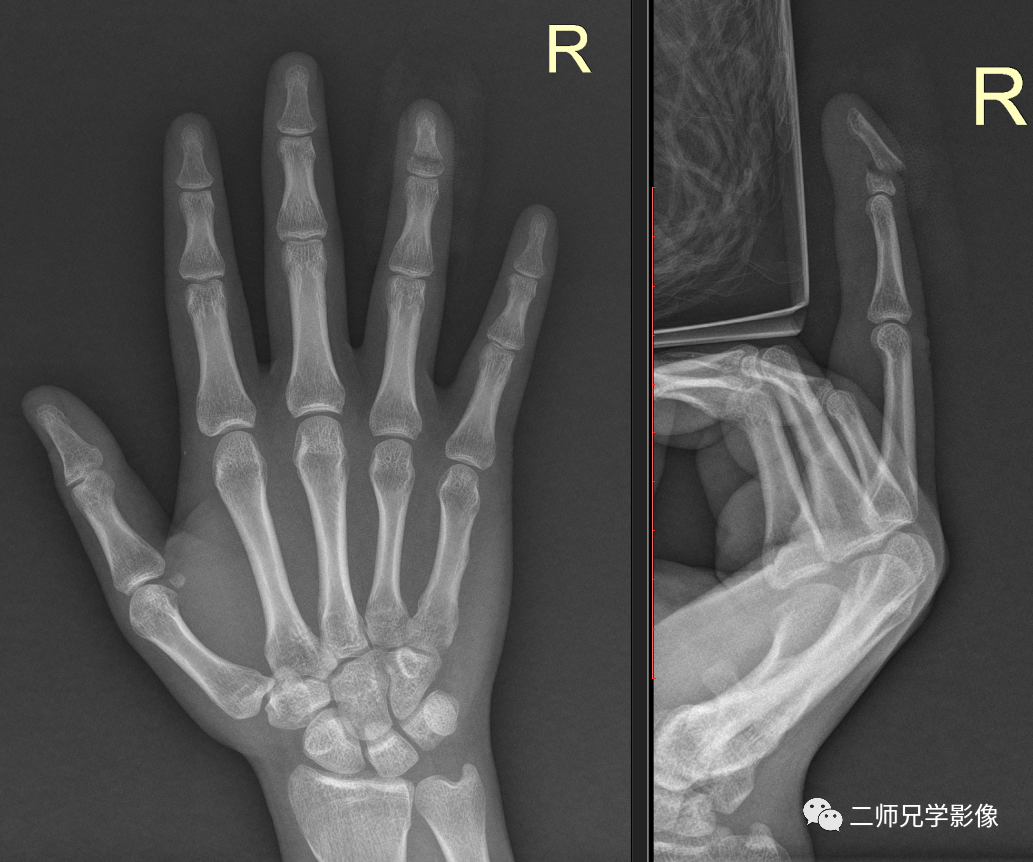 怎么取放射片放射拍片中的“几何学”，临床医生和技师都掌握了吗？_https://www.jmylbn.com_新闻资讯_第13张