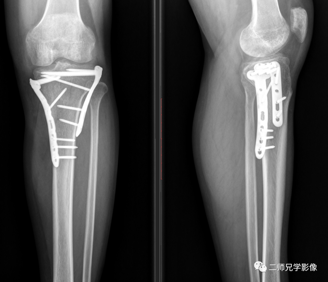 怎么取放射片放射拍片中的“几何学”，临床医生和技师都掌握了吗？_https://www.jmylbn.com_新闻资讯_第11张