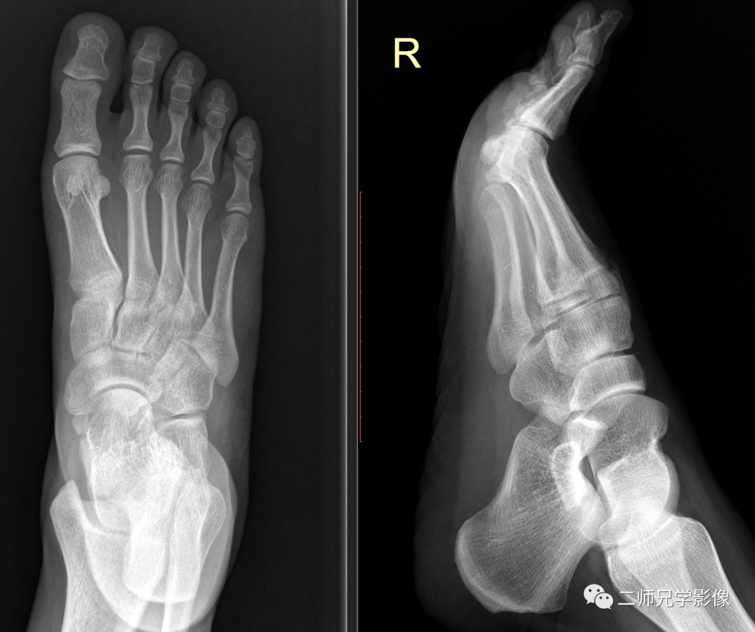 怎么取放射片放射拍片中的“几何学”，临床医生和技师都掌握了吗？_https://www.jmylbn.com_新闻资讯_第2张