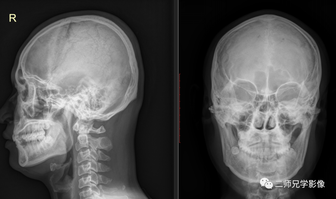 怎么取放射片放射拍片中的“几何学”，临床医生和技师都掌握了吗？_https://www.jmylbn.com_新闻资讯_第12张